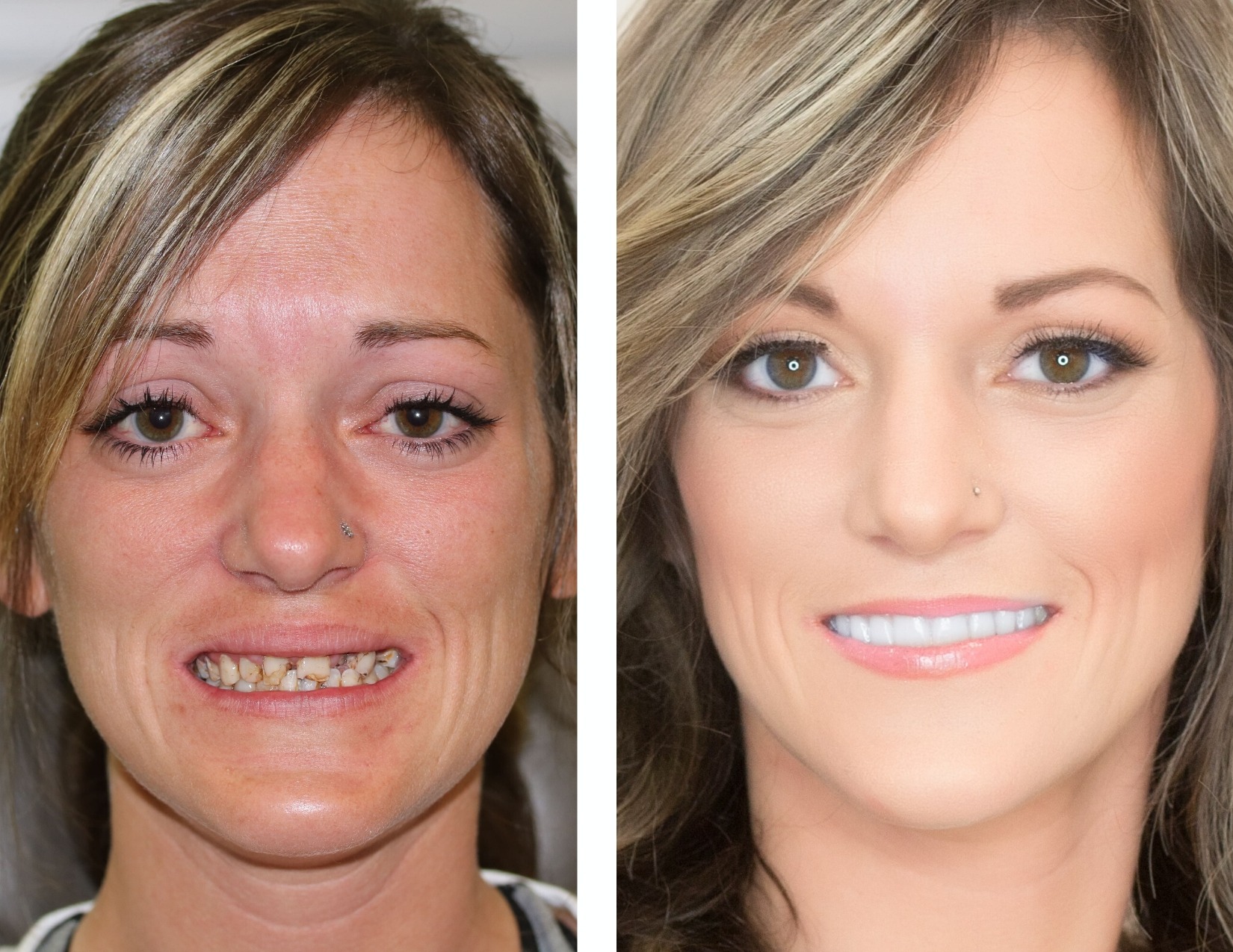 Before And After Pictures Of Dental Implants
